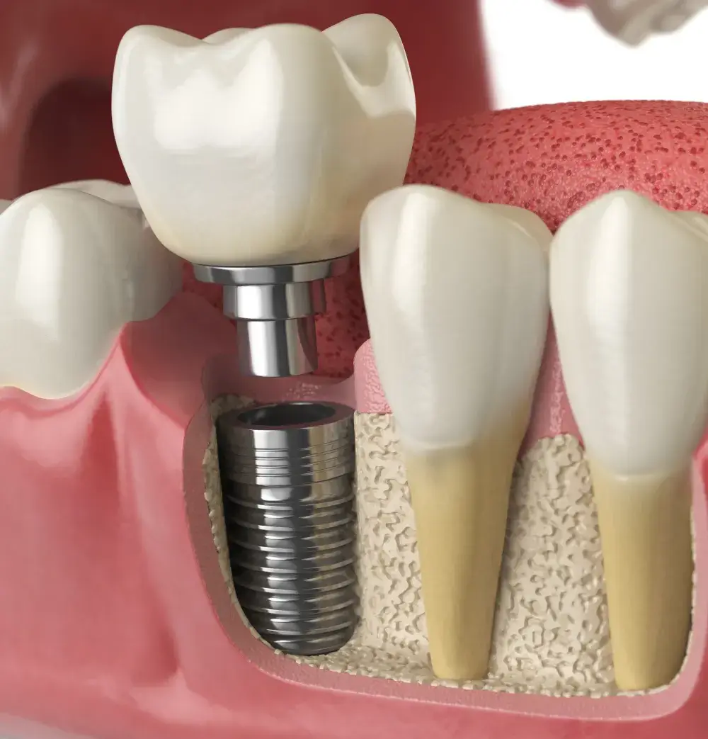 dental-implants-lynn-valley dental-implants-lynn-valley