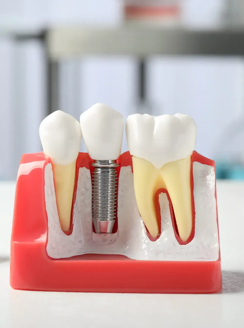 dental-implants-lynn-vally-north-vancouver dental-implants-lynn-vally-north-vancouver