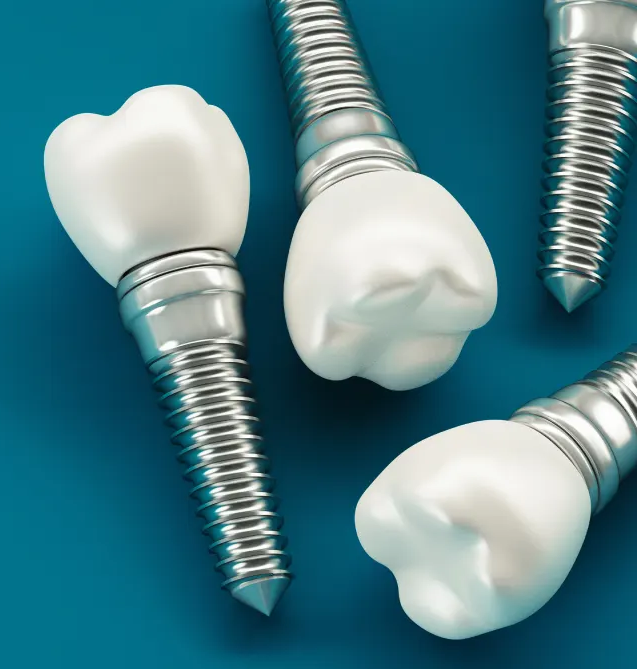 dental-implants-why-lynn-valley dental-implants-why-lynn-valley
