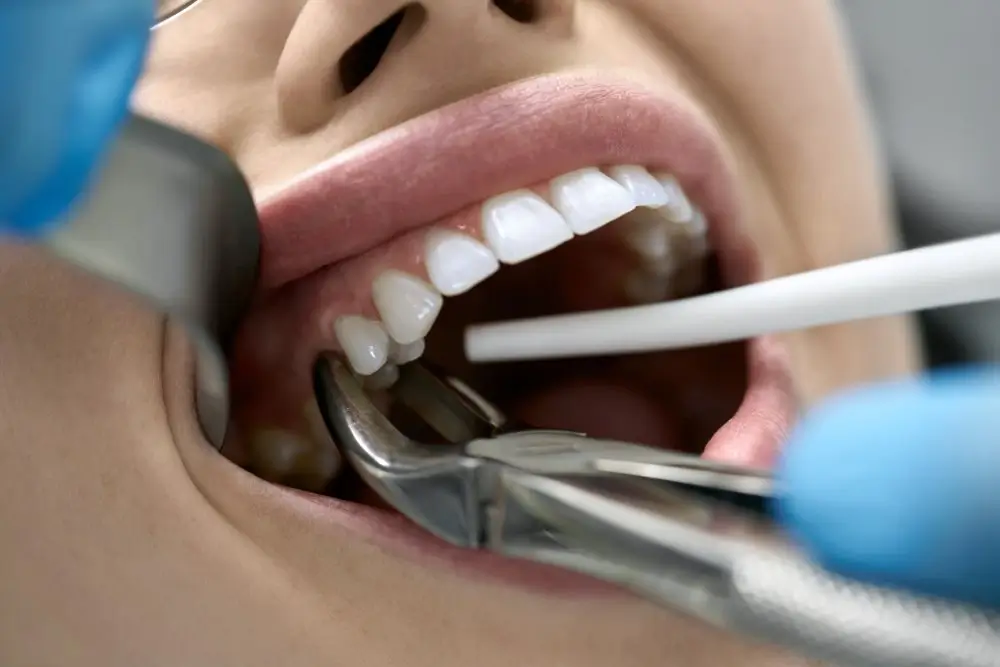 tooth-extraction-lynn-valley tooth-extraction-lynn-valley
